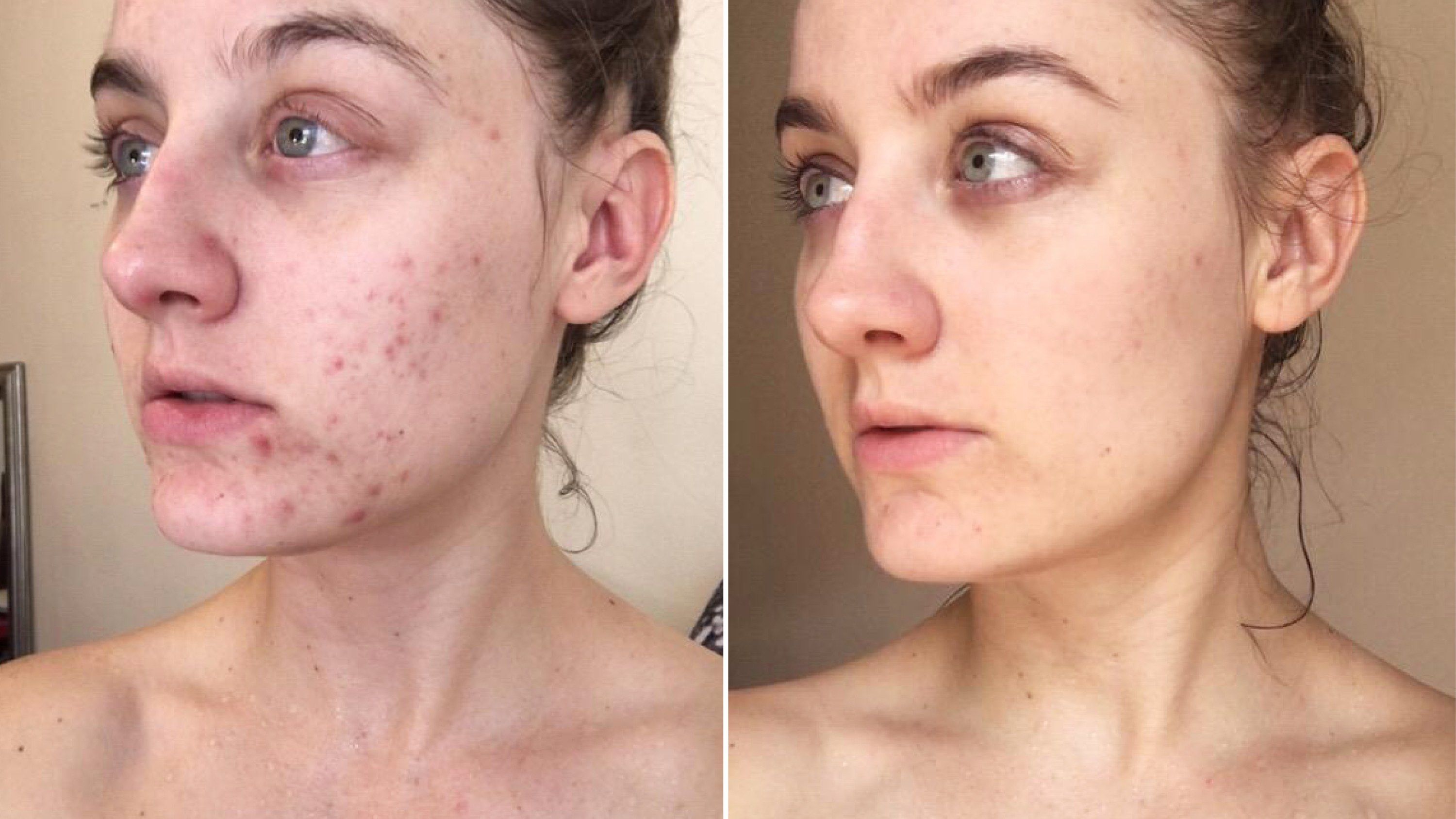 This Woman Swapped Her Cleanser for Micellar Water — and the Results Are  SHOCKING | Skin makeup, Micellar water acne, Beauty skin care routine